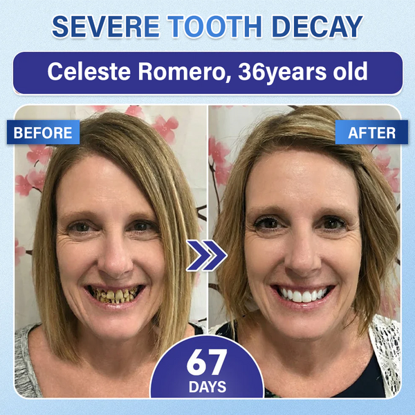 Lumina Tooth & Gum Repair Fast-Dissolving Microneedle Patch✨ (𝟓-𝐢𝐧-𝟏 💎 𝐑𝐞𝐛𝐮𝐢𝐥𝐝 𝐄𝐧𝐚𝐦𝐞𝐥 & 𝐃𝐞𝐧𝐭𝐢𝐧 • 𝐒𝐭𝐫𝐞𝐧𝐠𝐭𝐡𝐞𝐧 𝐆𝐮𝐦𝐬 • 𝐄𝐫𝐚𝐝𝐢𝐜𝐚𝐭𝐞 𝐓𝐚𝐫𝐭𝐚𝐫 & 𝐎𝐝𝐨𝐫 • 𝐖𝐡𝐢𝐭𝐞𝐧𝐢𝐧𝐠 • 𝐒𝐭𝐨𝐩 𝐓𝐨𝐨𝐭𝐡 𝐒𝐞𝐧𝐬𝐢𝐭𝐢𝐯𝐢𝐭𝐲)