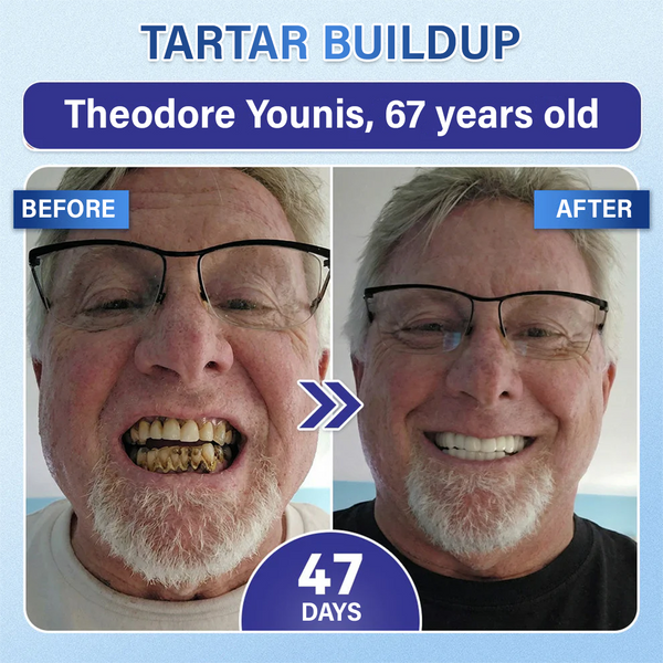Lumina Tooth & Gum Repair Fast-Dissolving Microneedle Patch✨ (𝟓-𝐢𝐧-𝟏 💎 𝐑𝐞𝐛𝐮𝐢𝐥𝐝 𝐄𝐧𝐚𝐦𝐞𝐥 & 𝐃𝐞𝐧𝐭𝐢𝐧 • 𝐒𝐭𝐫𝐞𝐧𝐠𝐭𝐡𝐞𝐧 𝐆𝐮𝐦𝐬 • 𝐄𝐫𝐚𝐝𝐢𝐜𝐚𝐭𝐞 𝐓𝐚𝐫𝐭𝐚𝐫 & 𝐎𝐝𝐨𝐫 • 𝐖𝐡𝐢𝐭𝐞𝐧𝐢𝐧𝐠 • 𝐒𝐭𝐨𝐩 𝐓𝐨𝐨𝐭𝐡 𝐒𝐞𝐧𝐬𝐢𝐭𝐢𝐯𝐢𝐭𝐲)